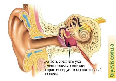 Inflammation of the middle ear